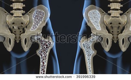 stock-photo-osteoporosis-391996339.jpg