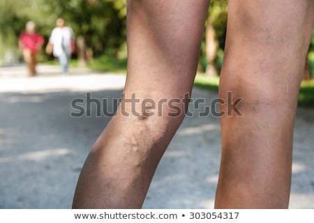 painful-varicose-spider-veins-on-450w-303054317.jpg