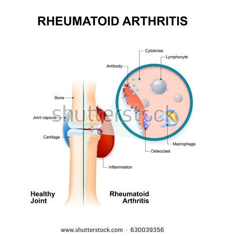 stock-vector-normal-joint-and-one-with-rheumatoid-arthritis-rheumatoid-arthritis-ra-is-an-auto-immune-disease-630039356.jpg