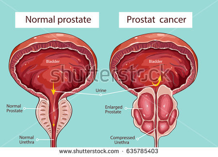 stock-vector-normal-prostate-and-acute-prostatitis-medical-illustration-635785403.jpg