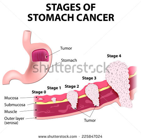 stock-vector-the-clinical-stages-of-stomach-cancer-classification-of-malignant-tumours-225847024.jpg