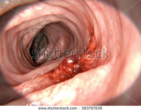 stock-photo-colorectal-cancer-d-rendering-583707838.jpg