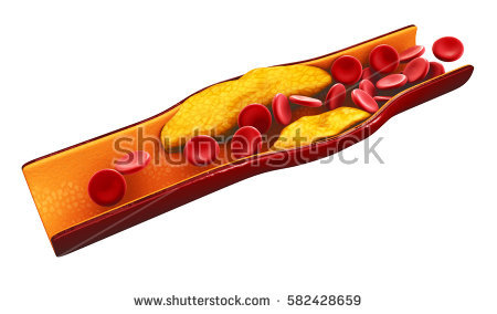 stock-photo--d-illustration-of-blood-cells-with-plaque-buildup-of-cholesterol-isolated-white-582428659.jpg
