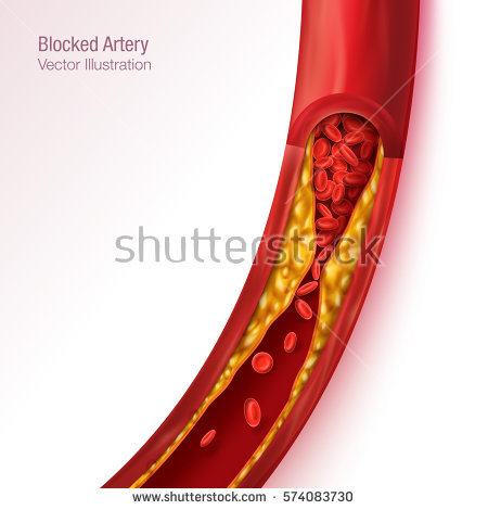 stock-vector-blocked-blood-vessel-artery-with-cholesterol-buildup-realistic-vector-illustration-isolated-574083730.jpg