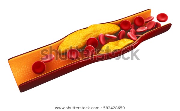 3d-illustration-blood-cells-plaque-600w-582428659.jpg