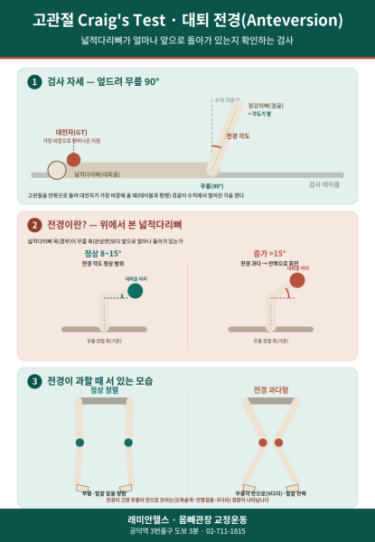 염리 교정운동 PT | 스쿼트할 때 발끝이 자꾸 안으로 모인다면, 고관절 전경부터 확인해 보세요 - 1 - 20260814000529
