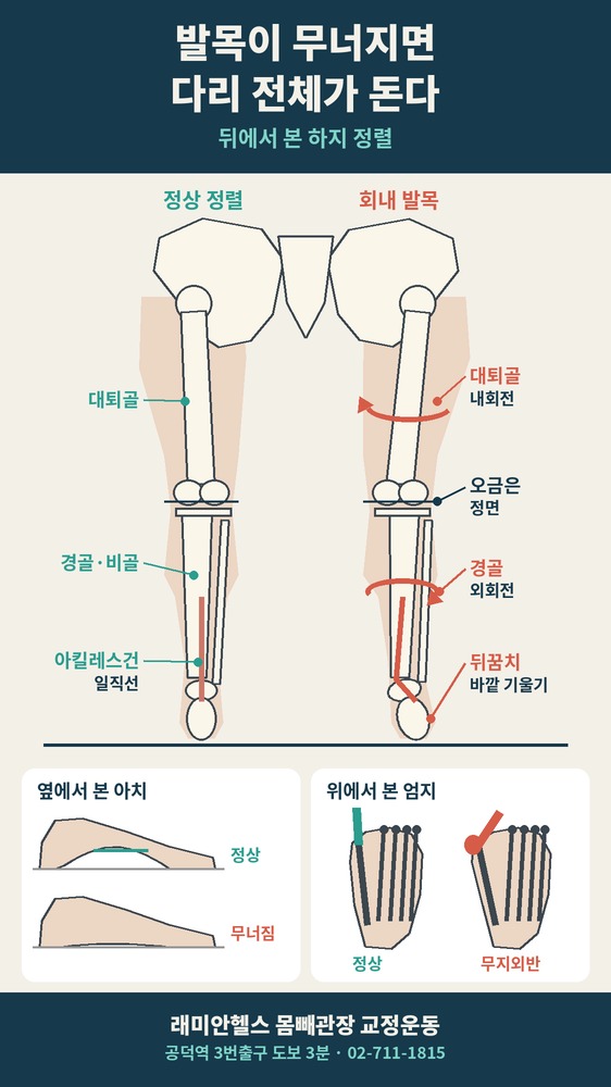 마포 교정운동 PT | 발 안쪽이 무너지면 무릎과 골반까지 돌아간다, 보행분석 2가지 사례 - 4 - 20261009001641