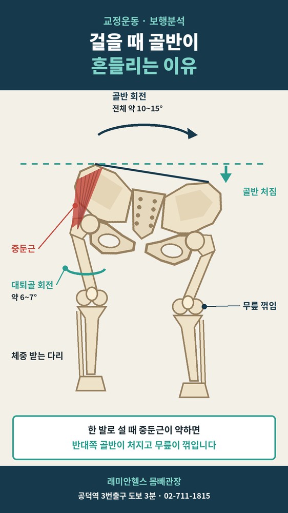 공덕 교정운동 PT | 헬스 걸을 때 골반이 흔들리는 이유, 보행분석으로 본 O다리 4가지 유형 - 1 - 20261013002213