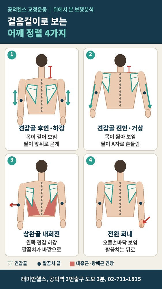 염리동 교정운동 PT | 걸을 때 팔이 흔들리는 모양으로 보는 어깨 정렬 4가지 - 3 - 20261015004029